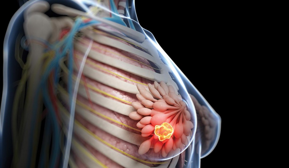 illustration of breast cancer