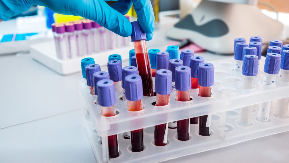 Picture of blood tests in a lab source Shutterstock