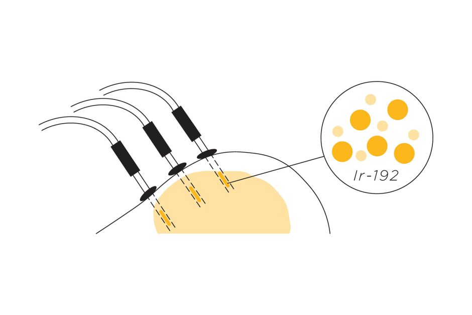 Graphic of Iridium0192 showing section of head and inset of Ir-192 molecules