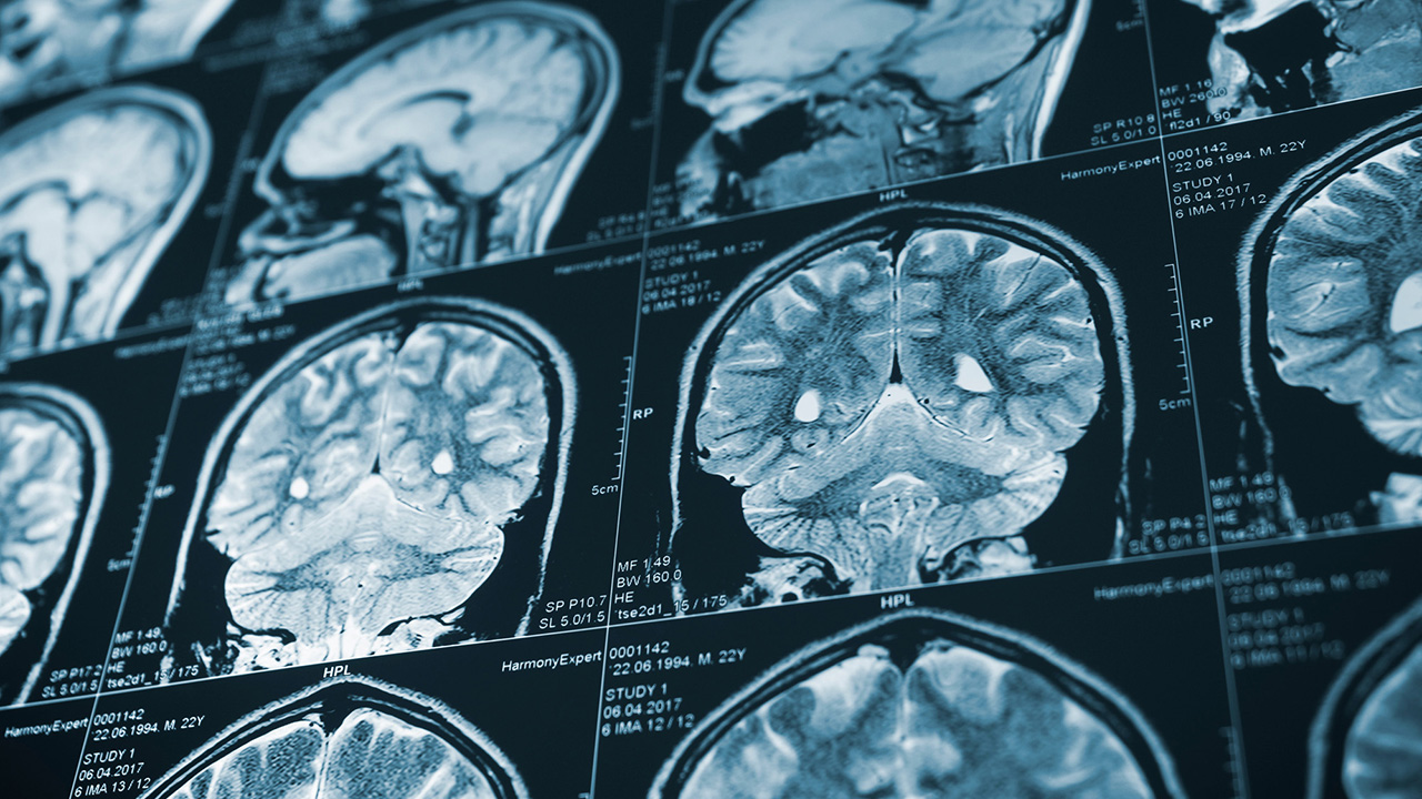 Researcher awarded nearly $3 million to study how brain repairs